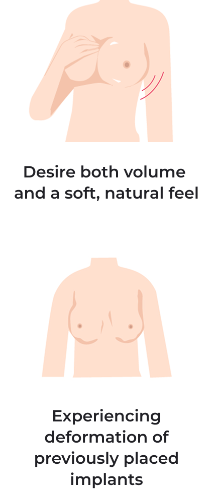 Desire both volume and a soft natural feel, experiencing deformation of previously placed implants