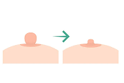 Nipple Reduction