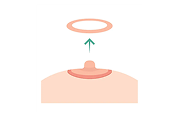 Areola Reduction