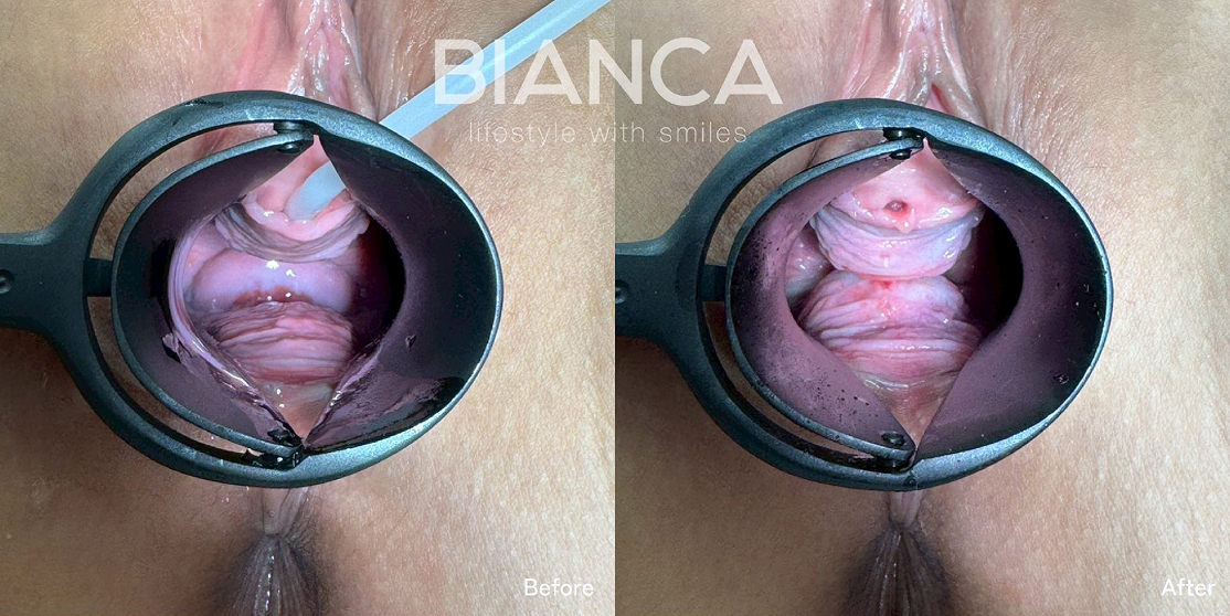 Vaginal hyaluronic acid injection case photo 1
