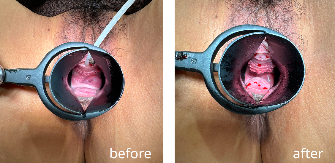 Vaginal hyaluronic acid injection case photo 2