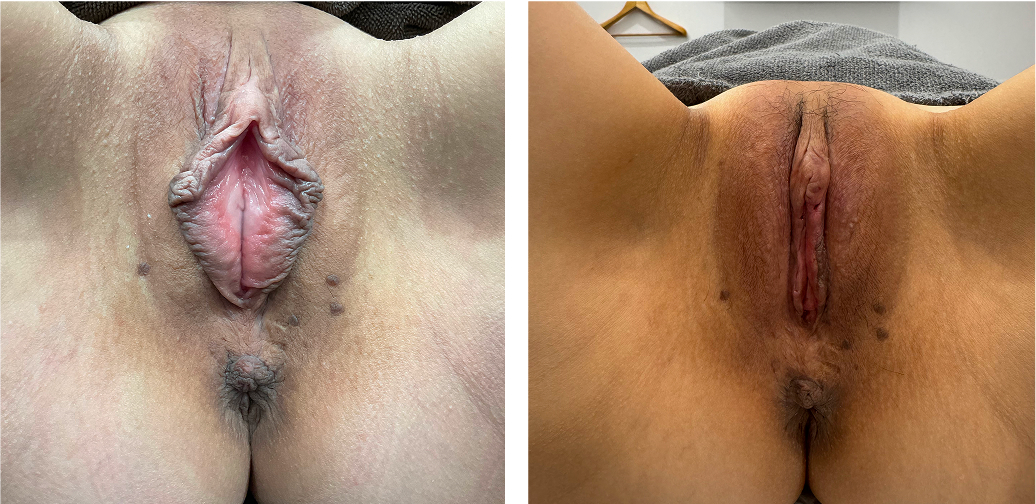Labia minora reduction, clitoral hood reduction, and labia majora hyaluronic acid injection case photo