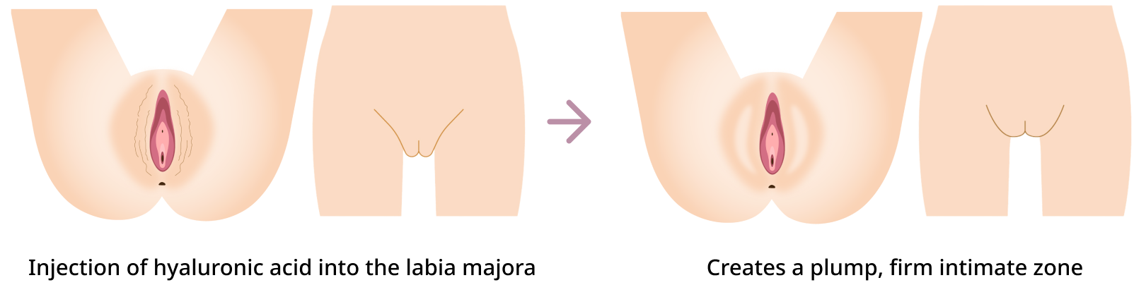 Labia majora hyaluronic acid injection procedure diagram