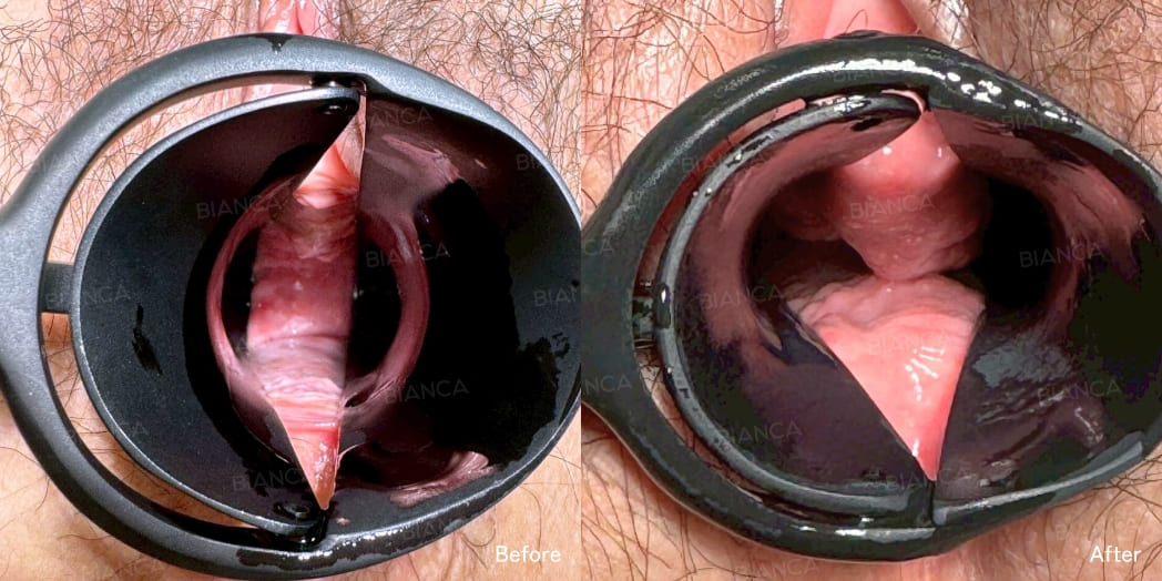 Vaginal hyaluronic acid injection case photo
