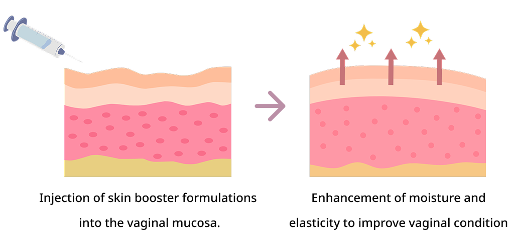 Vaginal rejuvenation injection procedure diagram