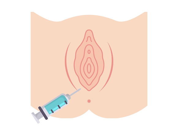 What is Dyspareunia Botox?