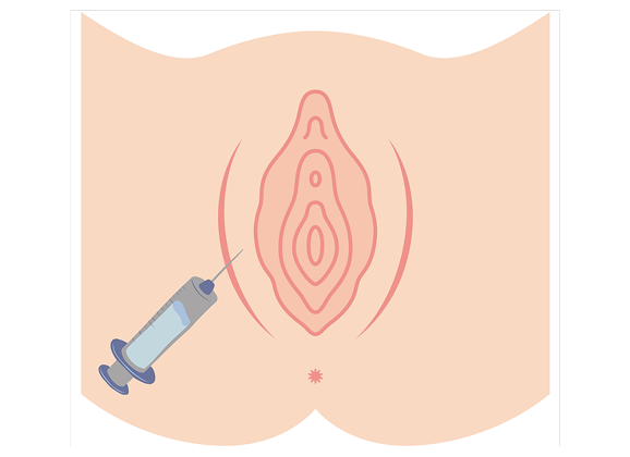 What is Botox for Dyspareunia?