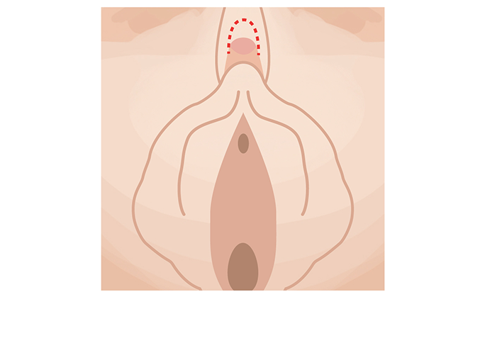 What is Clitoral Hood Reduction?