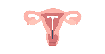 Those who are hesitant about having a device placed inside the uterus