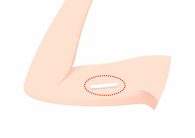 What is Contraceptive Implant?