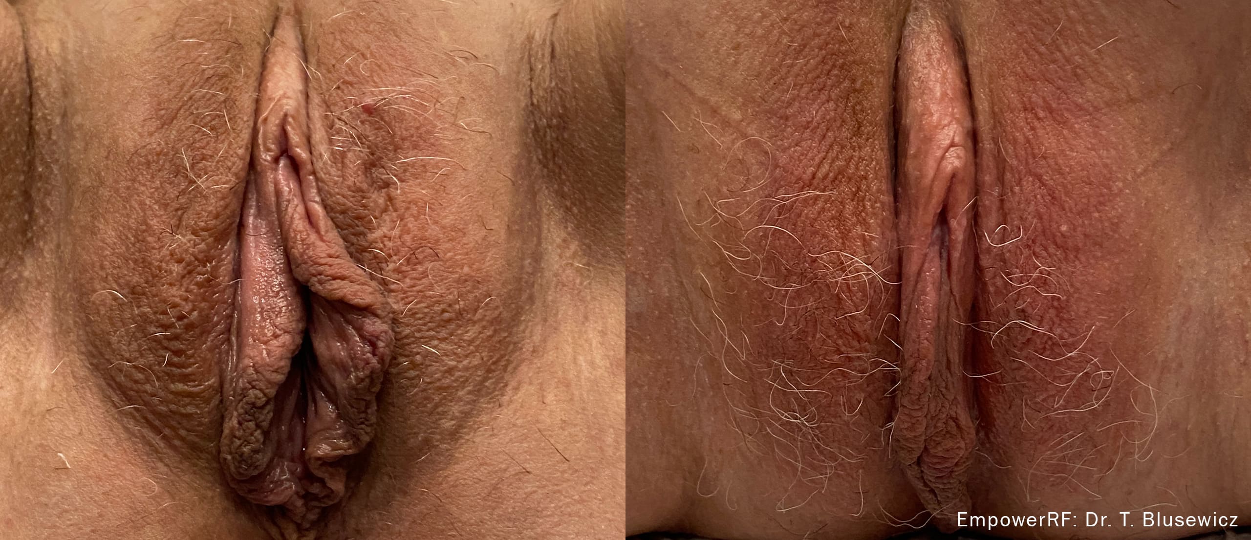 Empower RF case photo