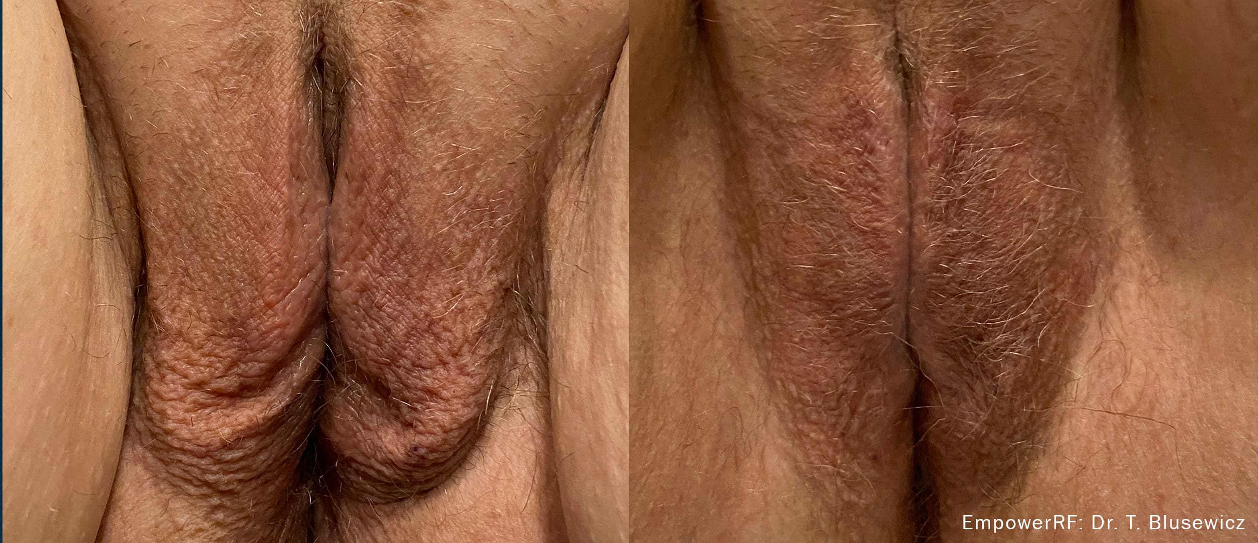 Empower RF case photo