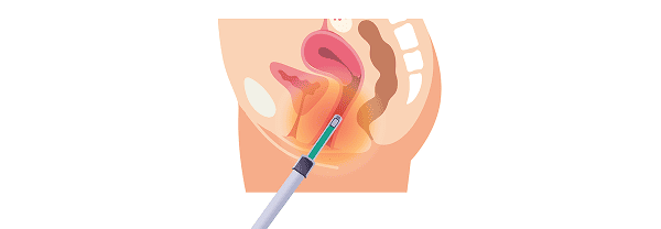 Treatment step: Ultra-fine needle applicator is inserted into vagina and external genital area