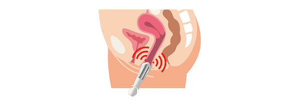 Treatment step: Intravaginal applicator is inserted and EMS induces repeated pelvic floor muscle contractions for several minutes