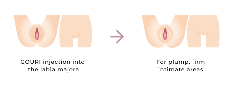 GOURI injection into the labia majora and plump, firm intimate areas