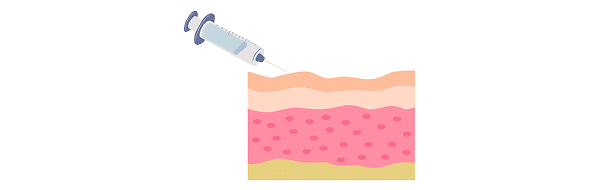 Treatment step: Using topical or local anesthesia, GOURI is evenly injected into the labia majora using cannula or fine needles.