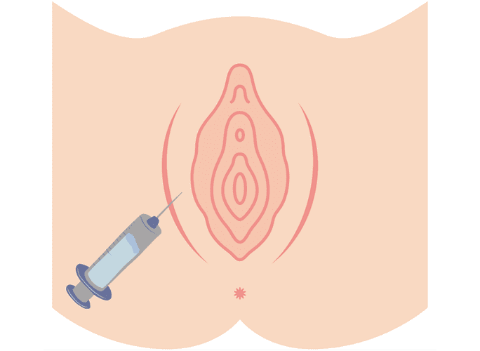 What is Labia Majora GOURI?