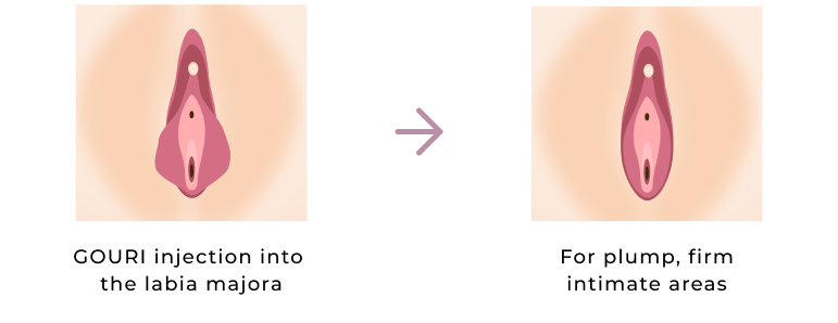 GOURI injection into the labia majora and plump, firm intimate areas