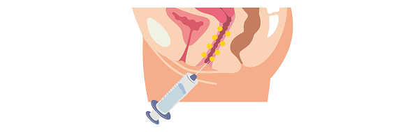 Treatment step: GOURI is injected in multiple fine points throughout the vaginal walls.