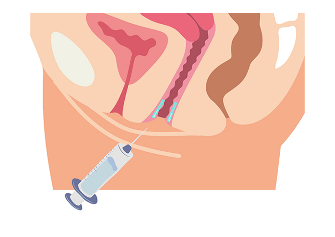 What is Vaginal GOURI?
