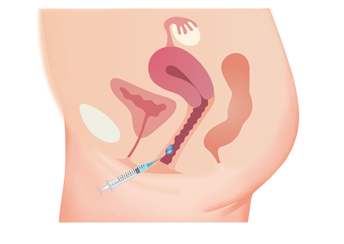 What is G-Shot Injection?