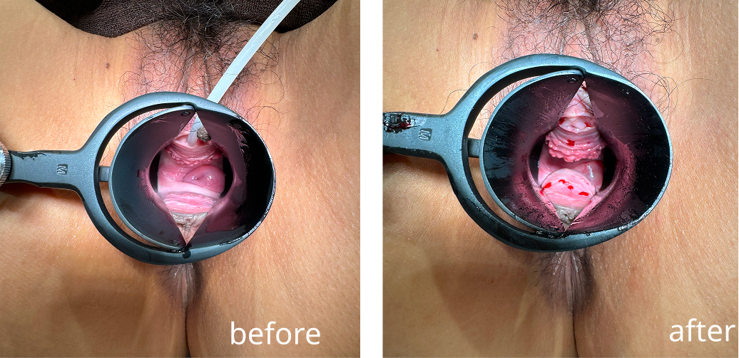 Vaginal hyaluronic acid injection case photo