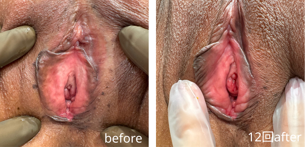 Vaginal rejuvenation injection case photo