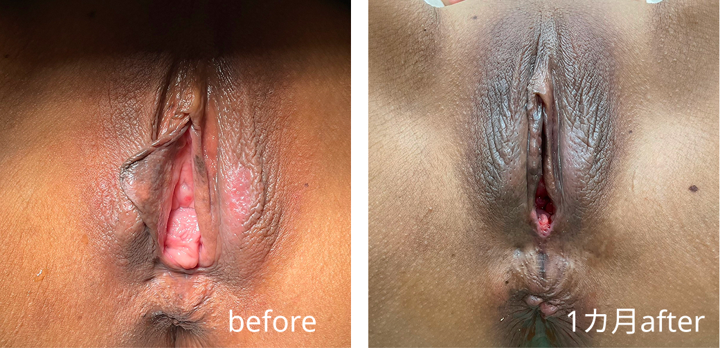 Vaginal wall reconstruction case photo