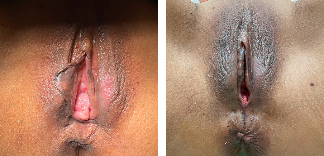 Vaginal opening reconstruction case photo