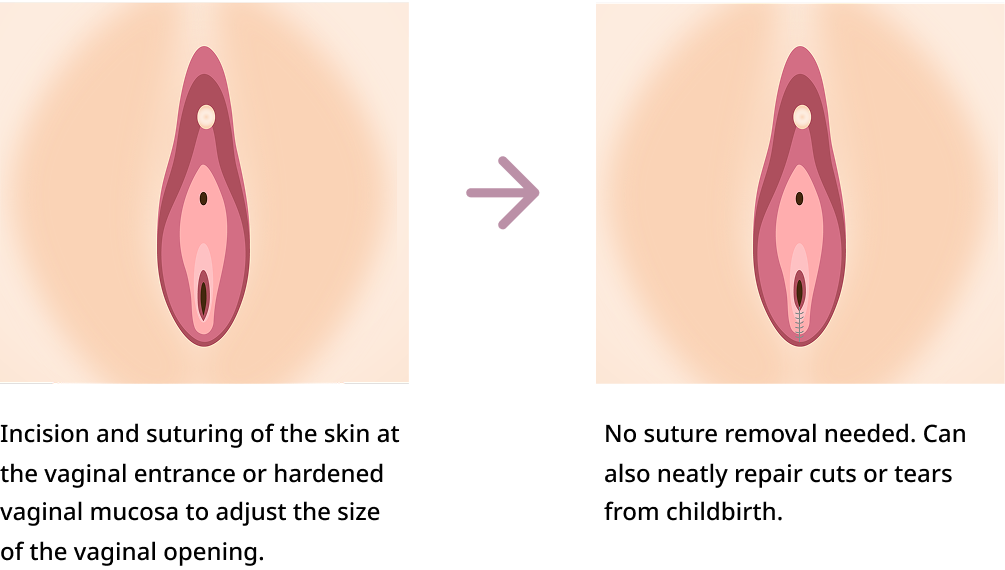 Vaginal opening reconstruction procedure diagram