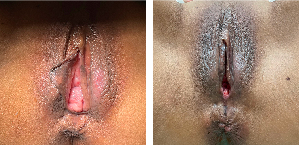 Vaginal wall reconstruction and vaginal opening reconstruction case photo