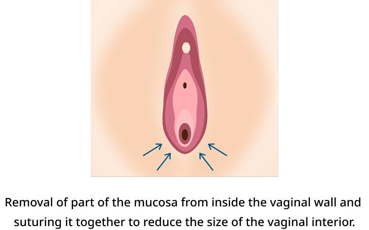 Vaginal wall reconstruction procedure diagram