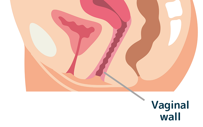 What is Vaginal Wall Reconstruction?