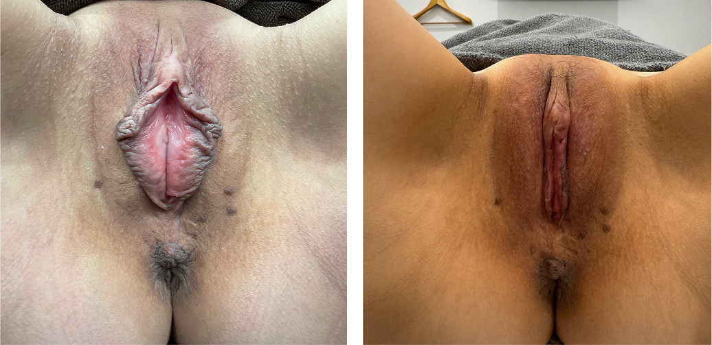Labia minora reduction, clitoral hood reduction, and labia majora hyaluronic acid injection case photo