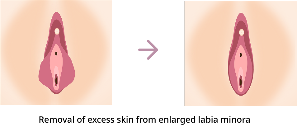 Labia minora reduction procedure diagram