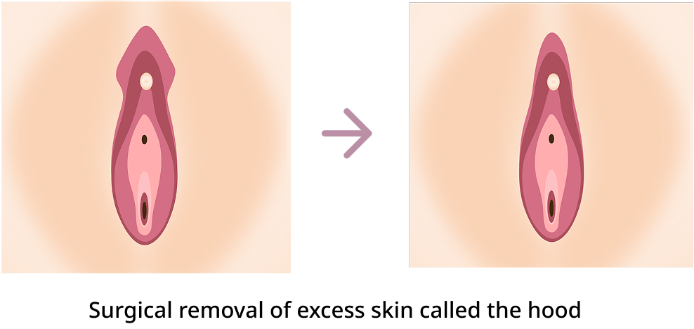Clitoral hood removal procedure diagram
