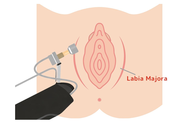 What is TriFill Pro for Intimate Area?