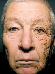 Why Wearing Sunscreen is Important