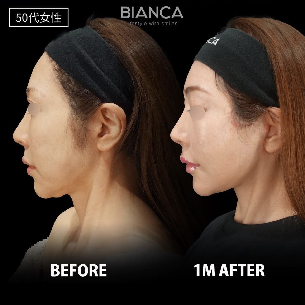 Deep Plane Facelift BIANCA in Tokyo, Japan