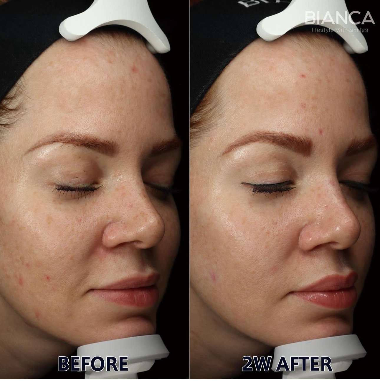 Pico Spot Treatment Pico Toning BIANCA in Tokyo, Japan