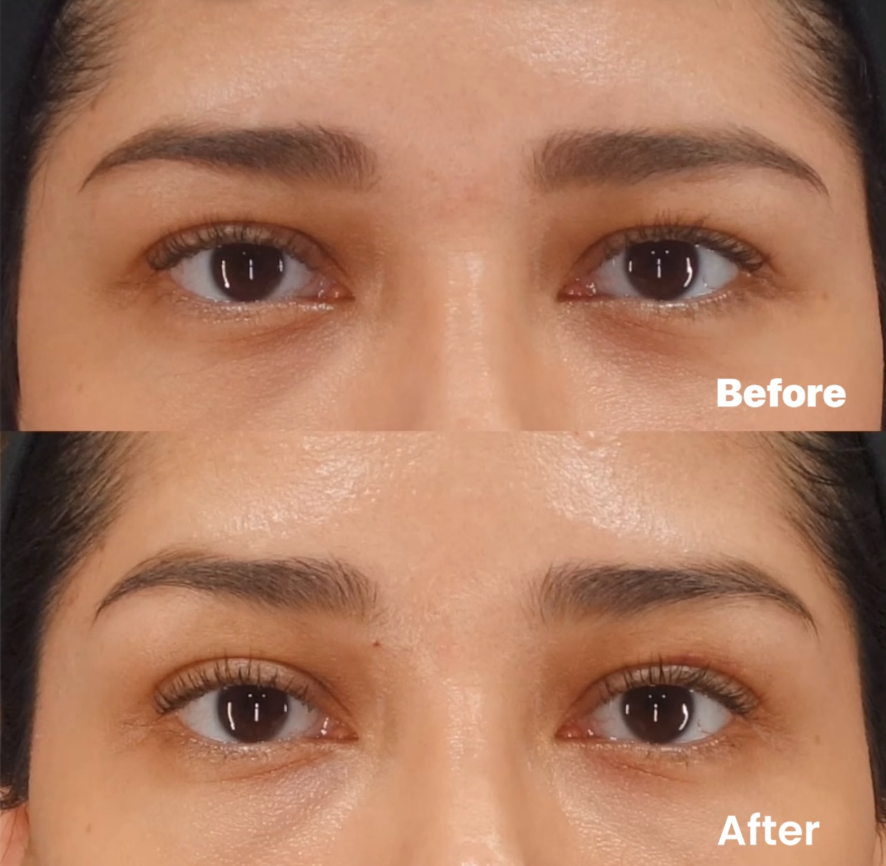 Fox Eye Lift BIANCA in Tokyo, Japan