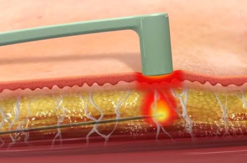 FaceTite -revolutionary tightening