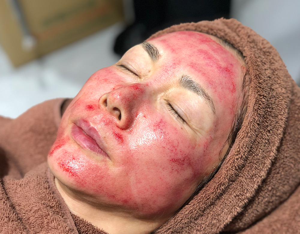 Vampire Facial