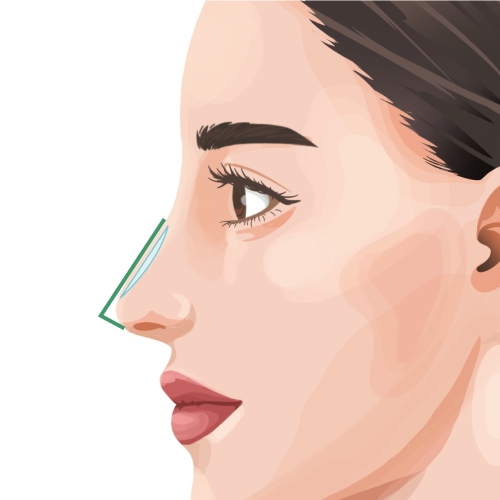 Preservation Rhinoplasty BIANCA in Tokyo, Japan