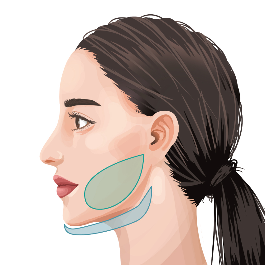 Vaser Face Liposuction