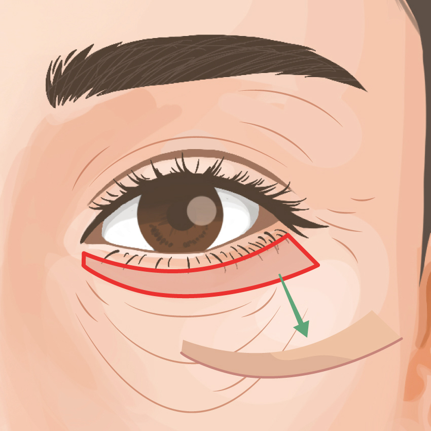 Lower Eyelid Sagging Removal｜BIANCA in Tokyo, Japan