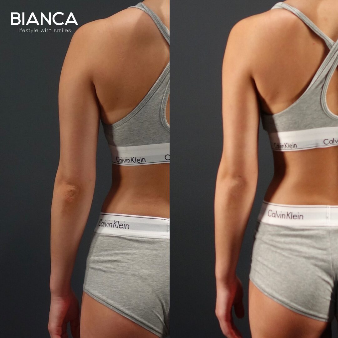 Body Vaser Liposuction｜BIANCA CLINIC in Tokyo, Japan