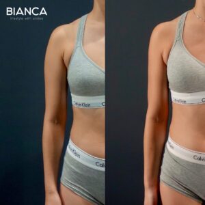 VASER Liposuction Plastic Surgery