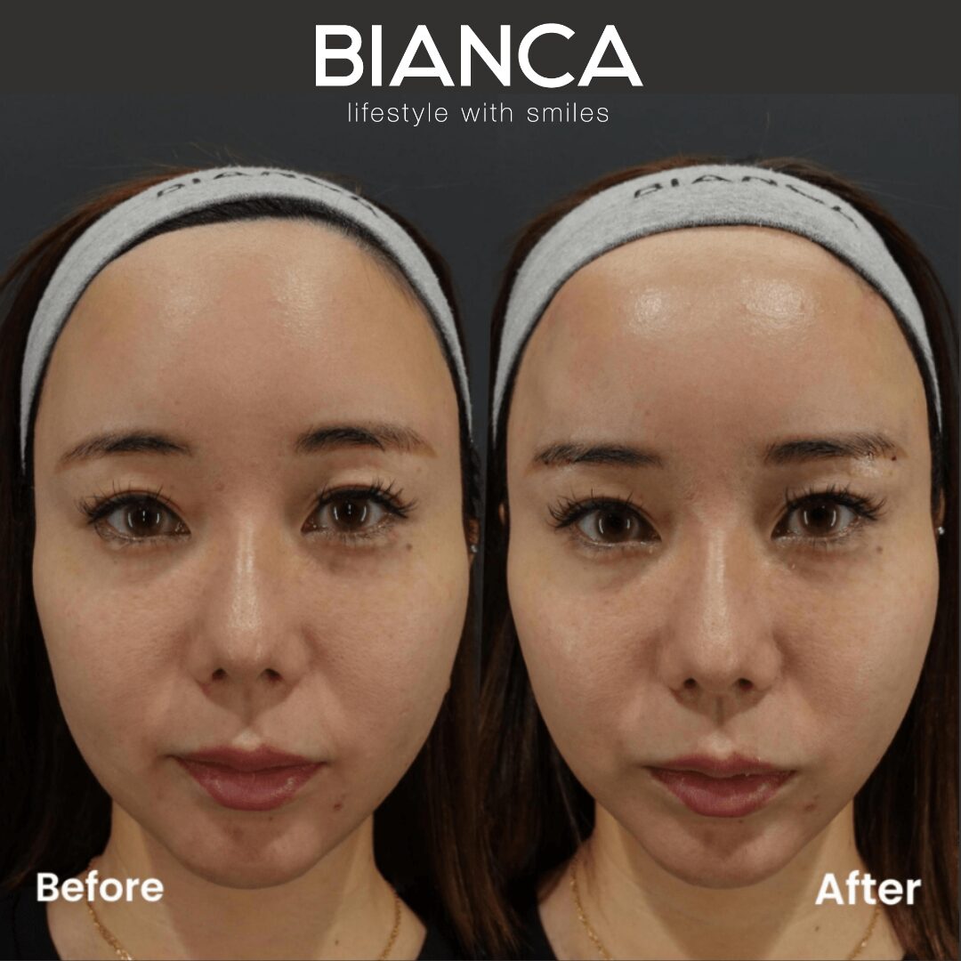 hooded eyes｜Trust BIANCA in Tokyo, Japan for Fox Eye Lift tailored to your hooded eyes. hooded eyes BIANCA in Tokyo, Japan