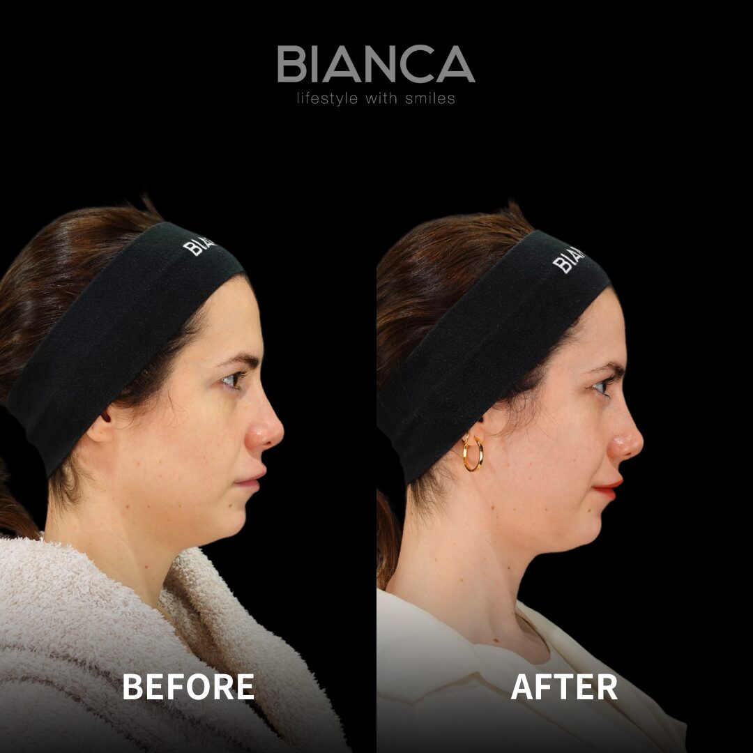 Vaser Lipo suction FaceMorpheus8 Embrace-Rf BIANCA in Tokyo, Japan